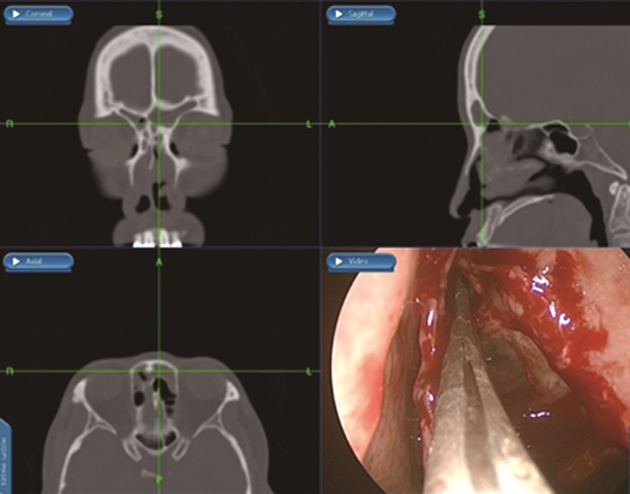 내비게이션 시스템으로 수술 중에 수술 부위를 확인하는 장면